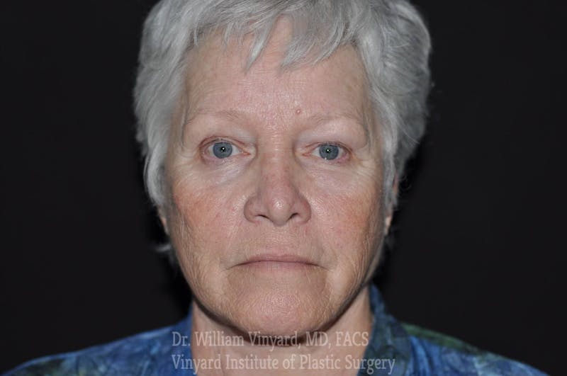 Laser Skin Resurfacing Before & After Gallery - Patient 169945858 - Image 1