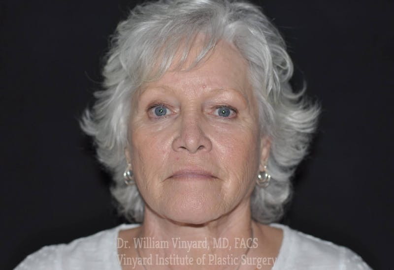 Laser Skin Resurfacing Before & After Gallery - Patient 169945858 - Image 2
