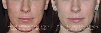 Laser Skin Resurfacing Before & After Gallery - Patient 169945905 - Image 1