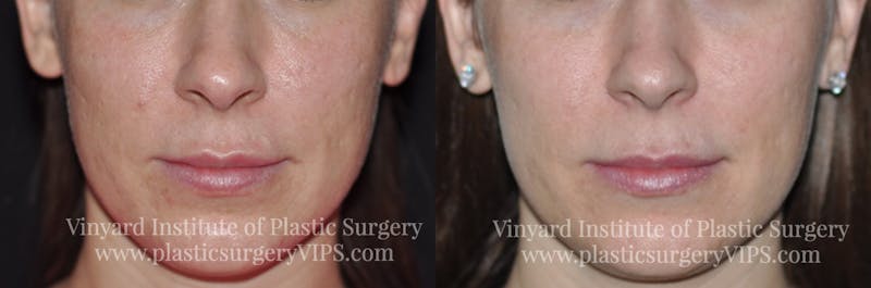 Laser Skin Resurfacing Before & After Gallery - Patient 169945905 - Image 1