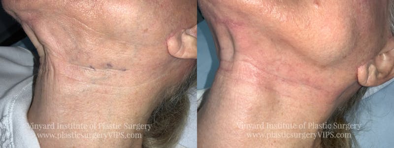 Laser Vein Removal Before & After Gallery - Patient 169946809 - Image 1