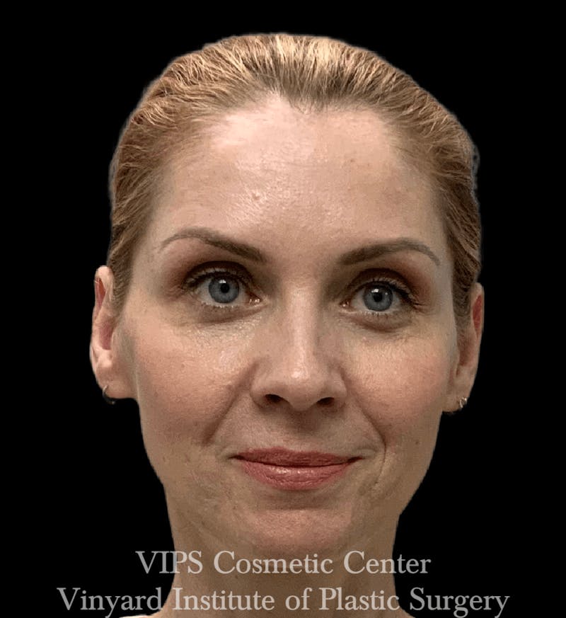 BOTOX® Before & After Gallery - Patient 171434591 - Image 4