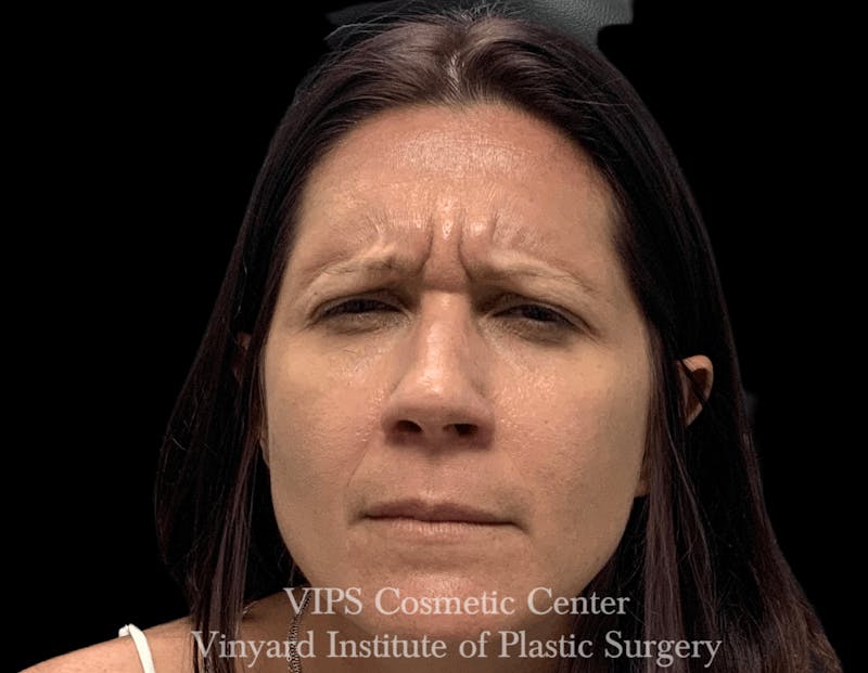 BOTOX® Before & After Gallery - Patient 171434606 - Image 1