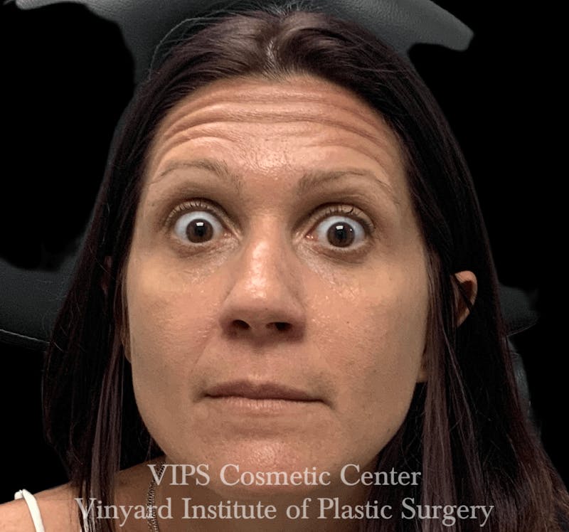 BOTOX® Before & After Gallery - Patient 171434606 - Image 3