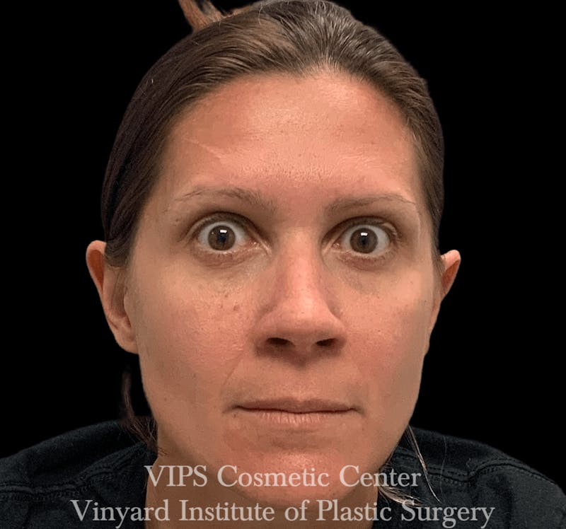 BOTOX® Before & After Gallery - Patient 171434606 - Image 4