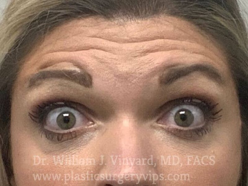 BOTOX® Before & After Gallery - Patient 171434620 - Image 1