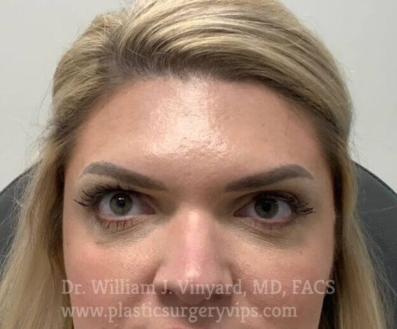 BOTOX® Before & After Gallery - Patient 171434620 - Image 2