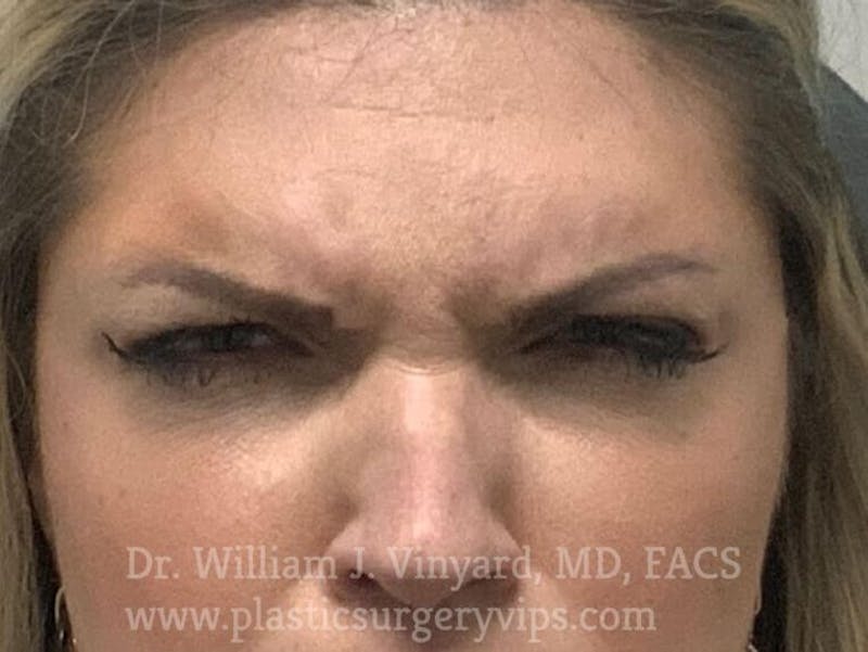 BOTOX® Before & After Gallery - Patient 171434620 - Image 3