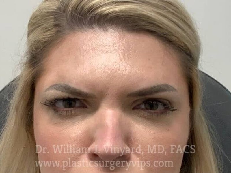 BOTOX® Before & After Gallery - Patient 171434620 - Image 4