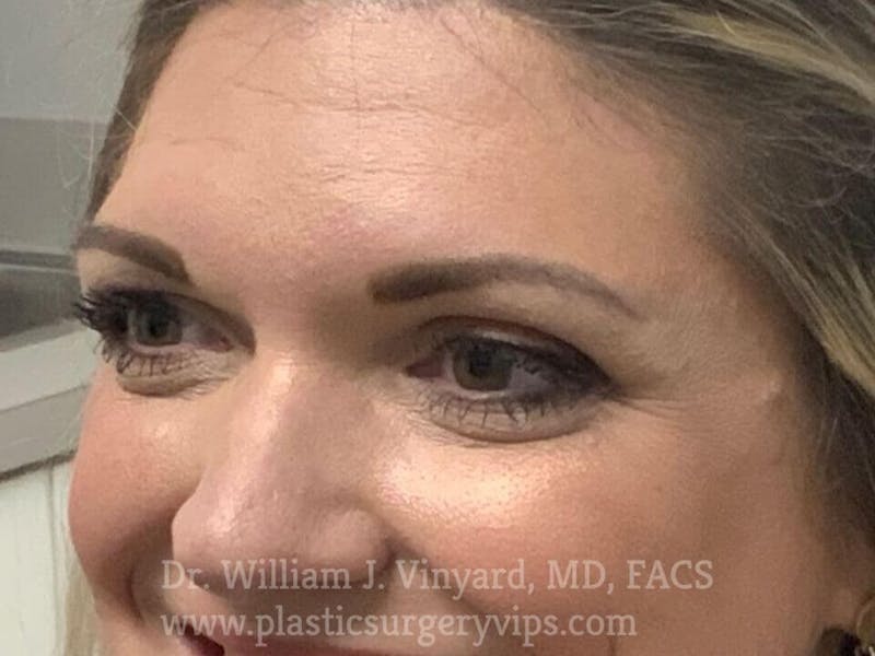 BOTOX® Before & After Gallery - Patient 171434620 - Image 5