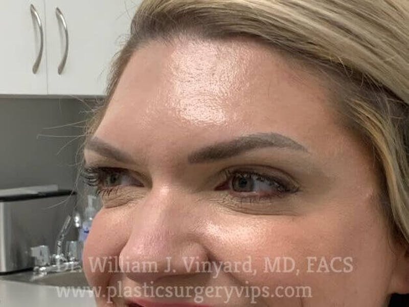BOTOX® Before & After Gallery - Patient 171434620 - Image 6