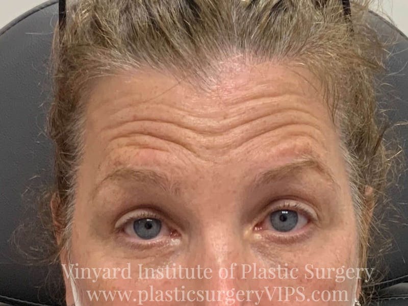 BOTOX® Before & After Gallery - Patient 171434623 - Image 1
