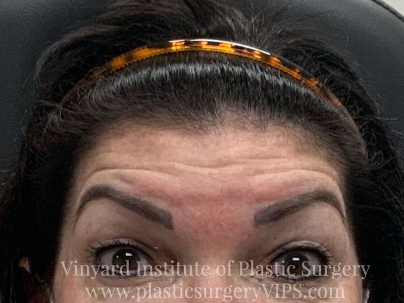 BOTOX® Before & After Gallery - Patient 171434644 - Image 1