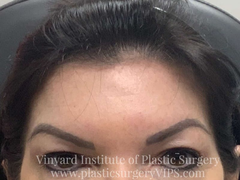 BOTOX® Before & After Gallery - Patient 171434644 - Image 2