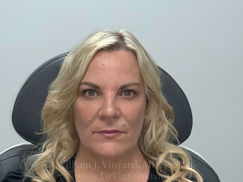 BOTOX® Before & After Gallery - Patient 171434701 - Image 2