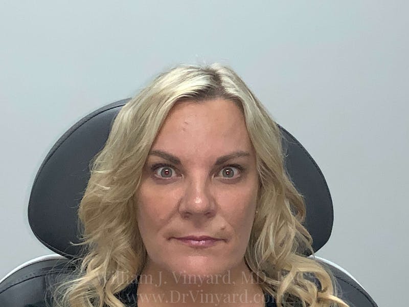 BOTOX® Before & After Gallery - Patient 171434701 - Image 4