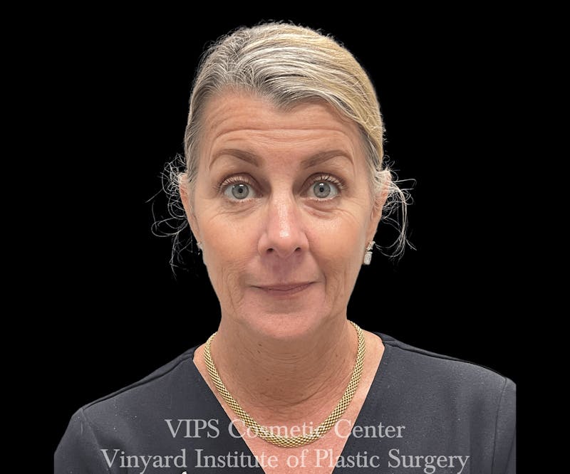 BOTOX® Before & After Gallery - Patient 171436067 - Image 1