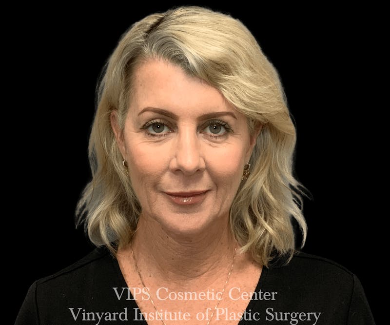 BOTOX® Before & After Gallery - Patient 171436067 - Image 2