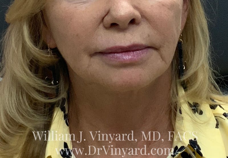 Wrinkle Fillers Before & After Gallery - Patient 171436072 - Image 1