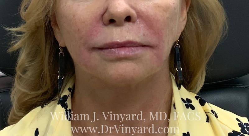Wrinkle Fillers Before & After Gallery - Patient 171436072 - Image 2