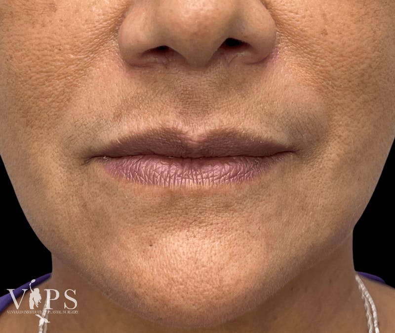 Lip Fillers Before & After Gallery - Patient 171436100 - Image 1