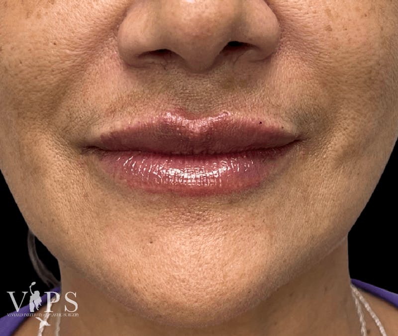 Lip Fillers Before & After Gallery - Patient 171436100 - Image 2