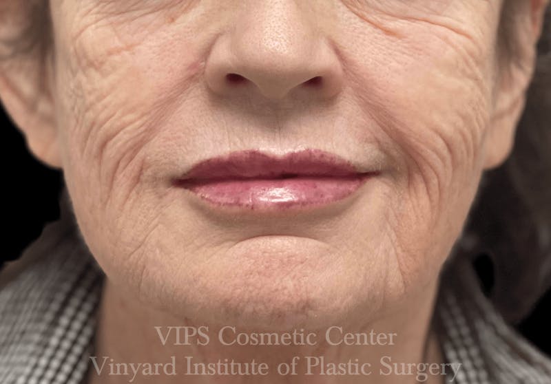 Lip Fillers Before & After Gallery - Patient 171436116 - Image 2