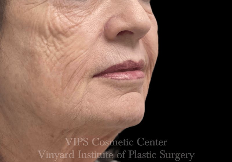 Lip Fillers Before & After Gallery - Patient 171436116 - Image 3