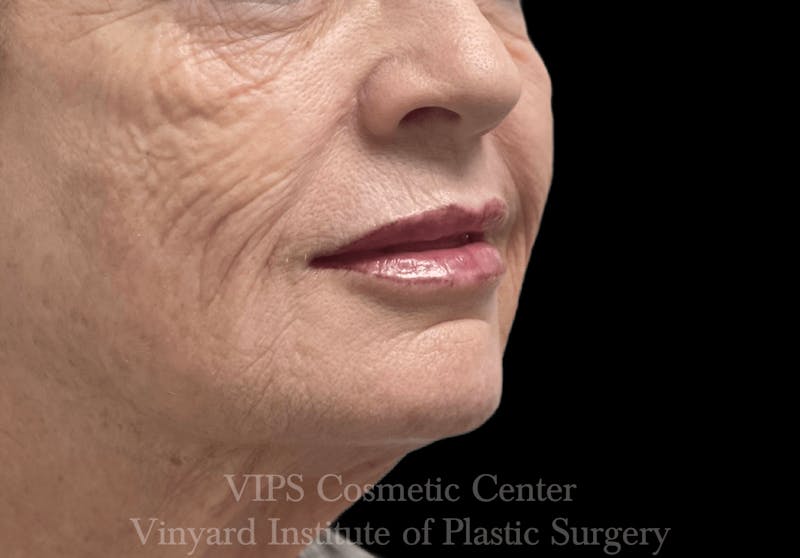 Lip Fillers Before & After Gallery - Patient 171436116 - Image 4