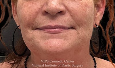 Lip Fillers Before & After Gallery - Patient 171436118 - Image 1