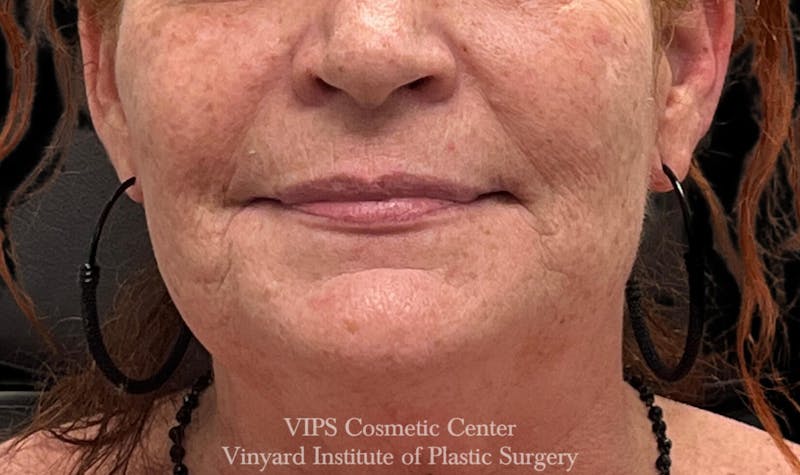 Lip Fillers Before & After Gallery - Patient 171436118 - Image 1
