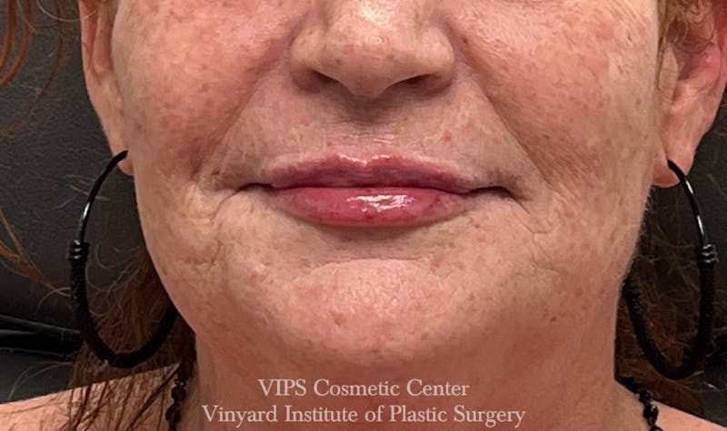 procedure7