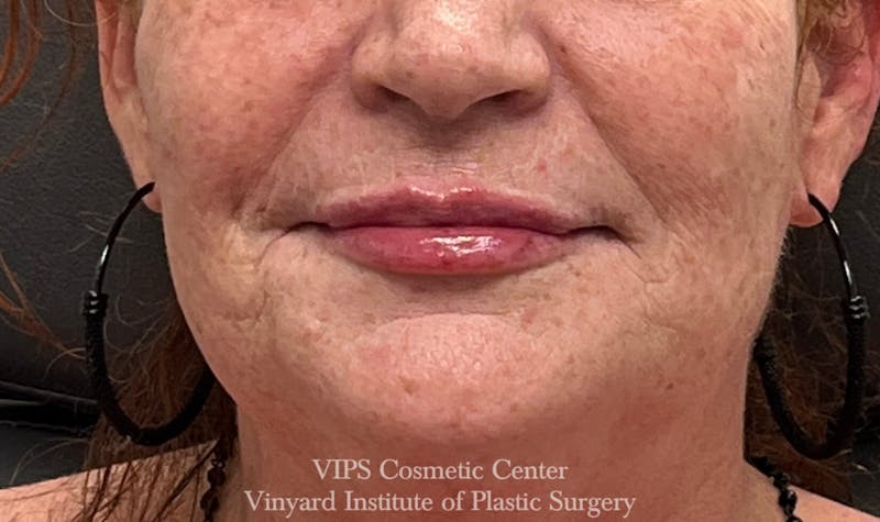 Lip Fillers Before & After Gallery - Patient 171436118 - Image 2