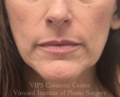 Lip Fillers Before & After Gallery - Patient 171436299 - Image 1