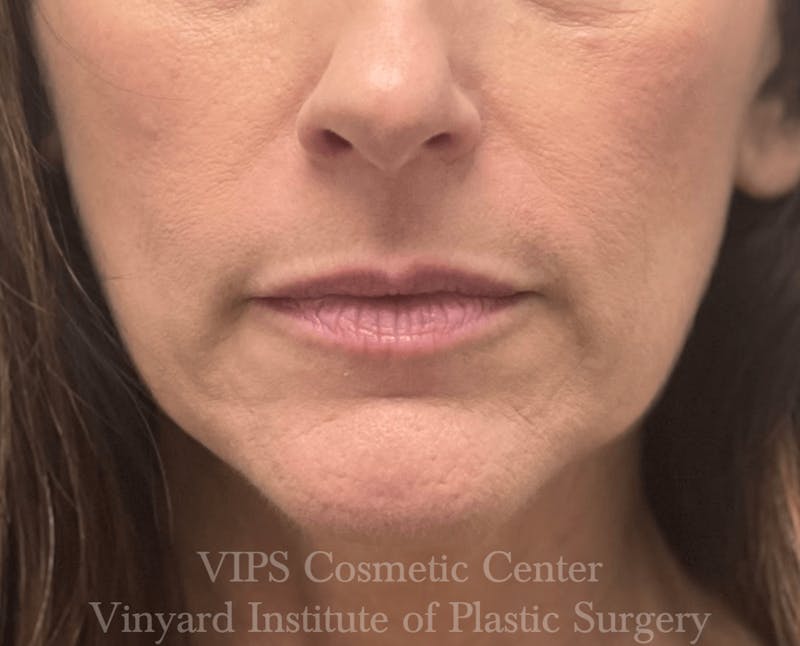 Lip Fillers Before & After Gallery - Patient 171436299 - Image 1