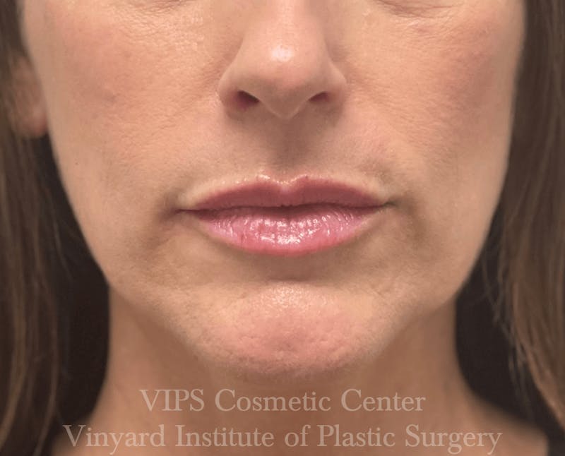 Lip Fillers Before & After Gallery - Patient 171436299 - Image 2