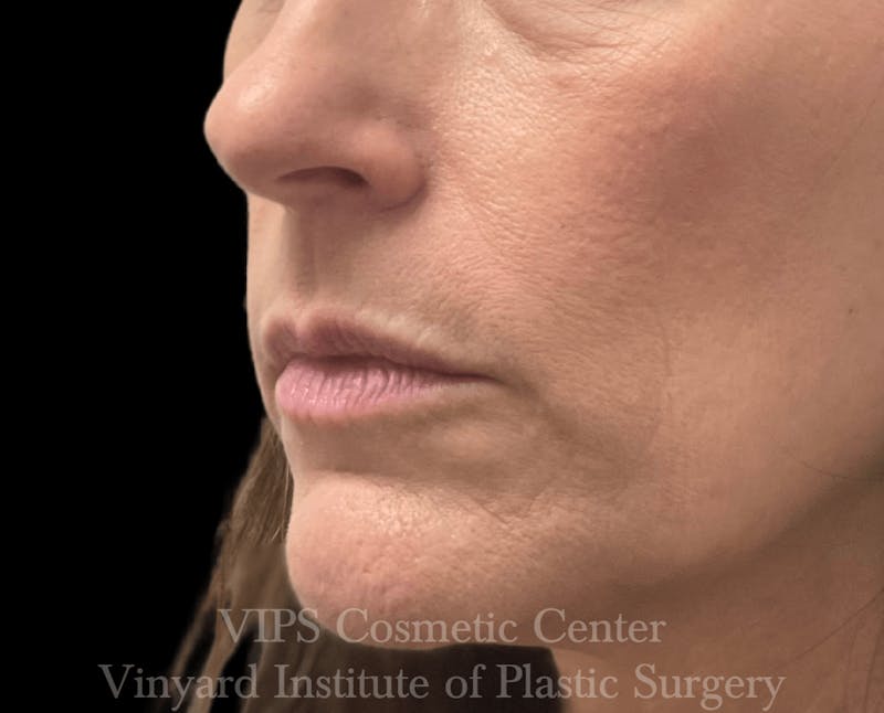Lip Fillers Before & After Gallery - Patient 171436299 - Image 3