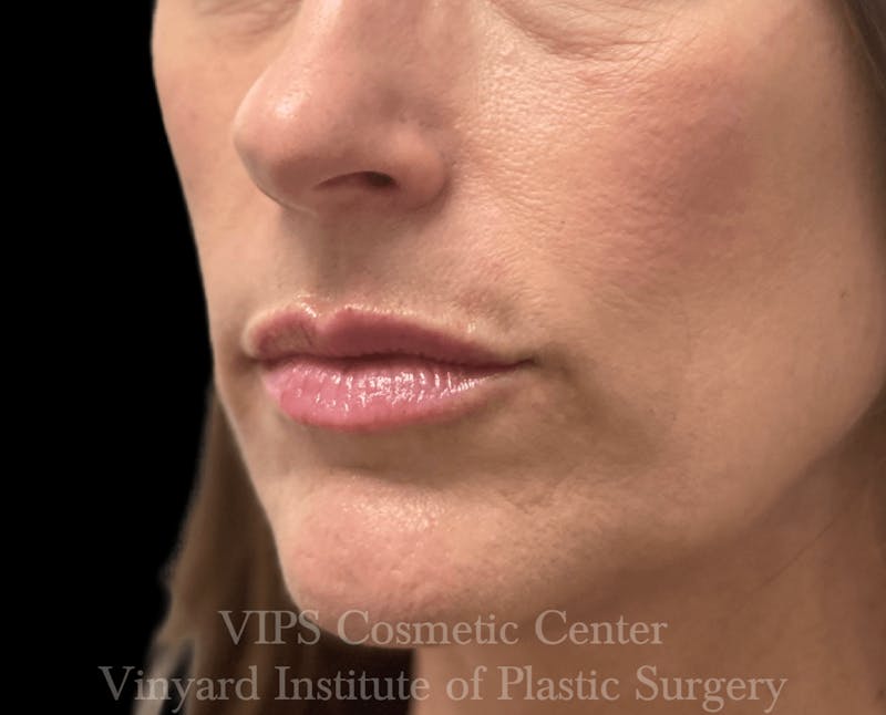 Lip Fillers Before & After Gallery - Patient 171436299 - Image 4