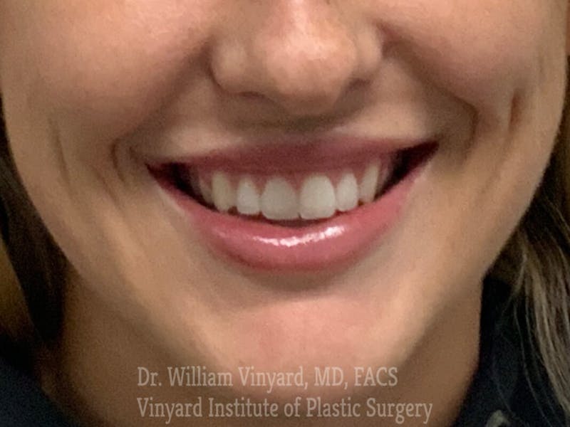 Lip Fillers Before & After Gallery - Patient 171436520 - Image 2