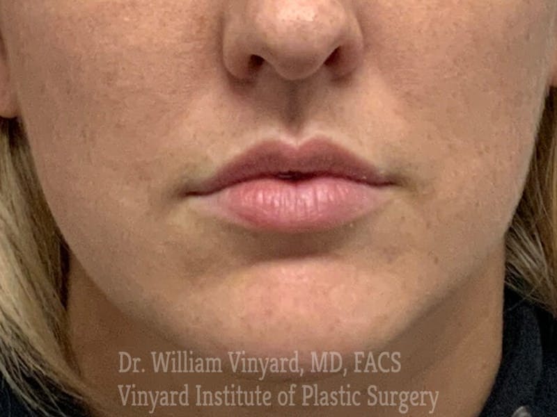 Lip Fillers Before & After Gallery - Patient 171436520 - Image 3