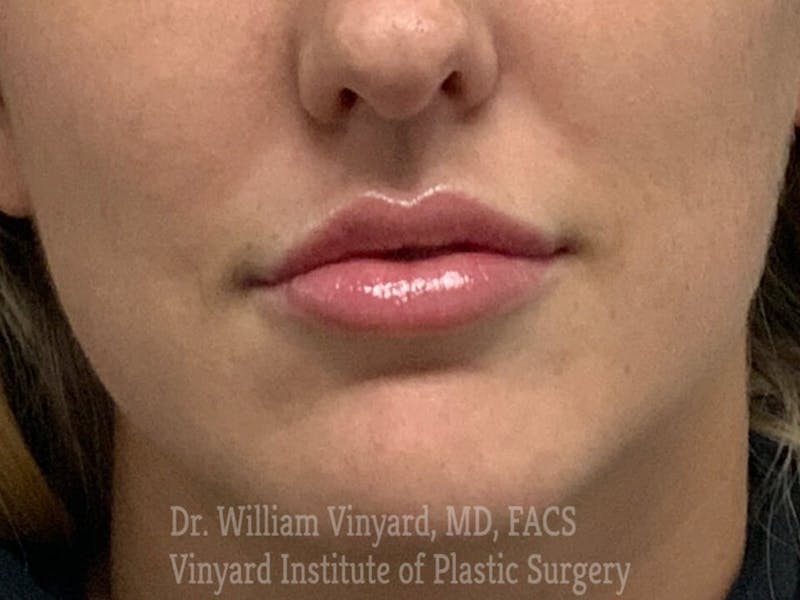 Lip Fillers Before & After Gallery - Patient 171436520 - Image 4