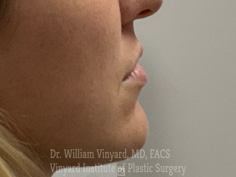 Lip Fillers Before & After Gallery - Patient 171436520 - Image 5