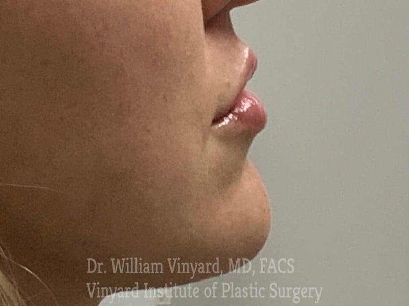Lip Fillers Before & After Gallery - Patient 171436520 - Image 6