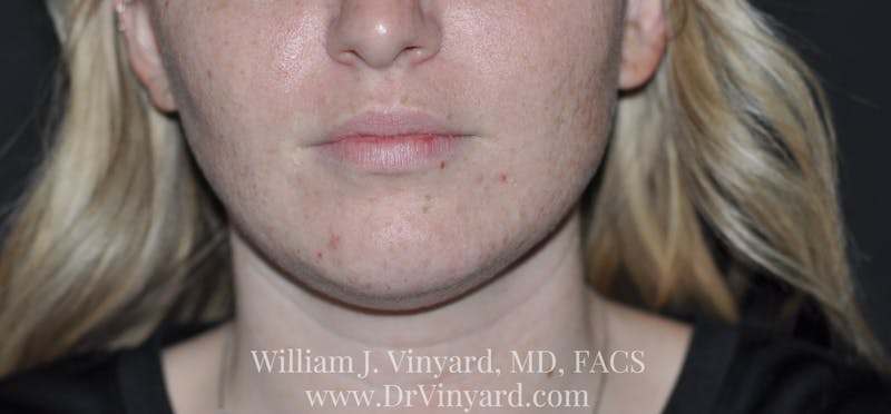 Lip Fillers Before & After Gallery - Patient 171436605 - Image 1