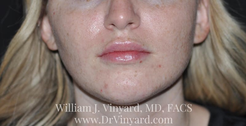 Lip Fillers Before & After Gallery - Patient 171436605 - Image 2