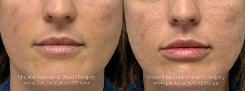 Lip Fillers Before & After Gallery - Patient 171436613 - Image 1