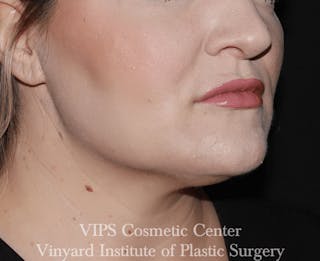 Coolsculpting ELITE Before & After Gallery - Patient 171436669 - Image 6