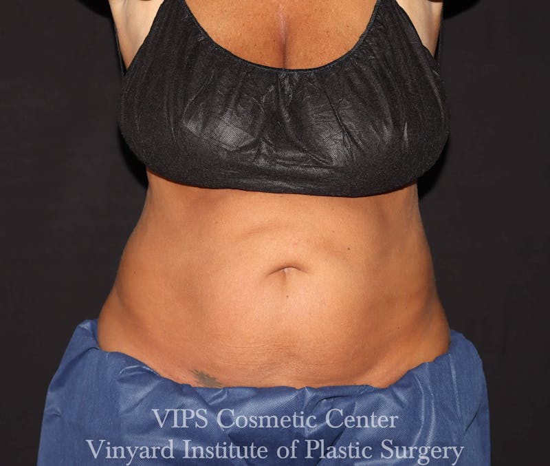 Coolsculpting ELITE Before & After Gallery - Patient 171436679 - Image 3