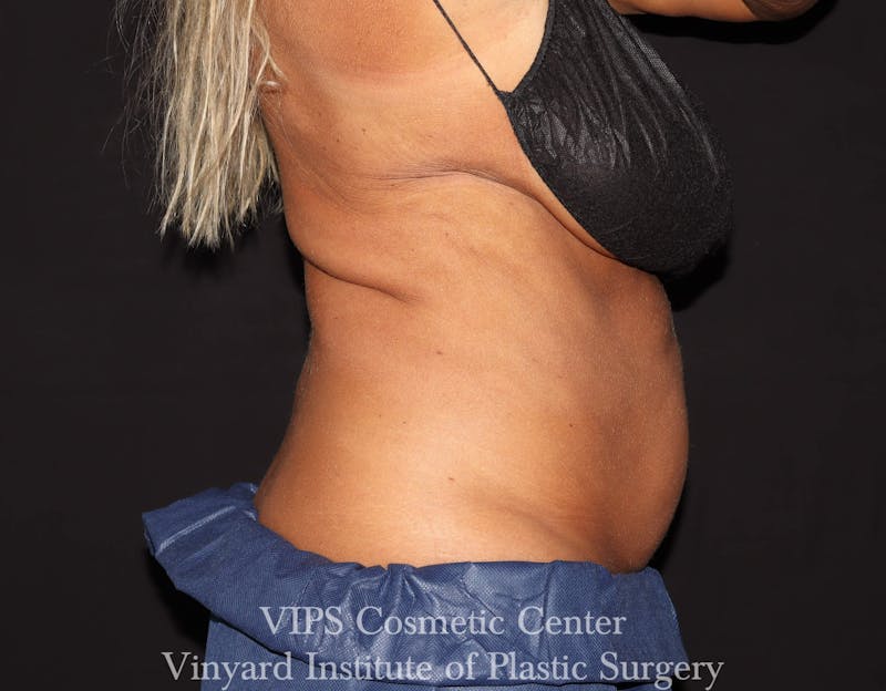 Coolsculpting ELITE Before & After Gallery - Patient 171436679 - Image 5