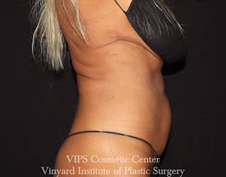 Coolsculpting ELITE Before & After Gallery - Patient 171436679 - Image 6